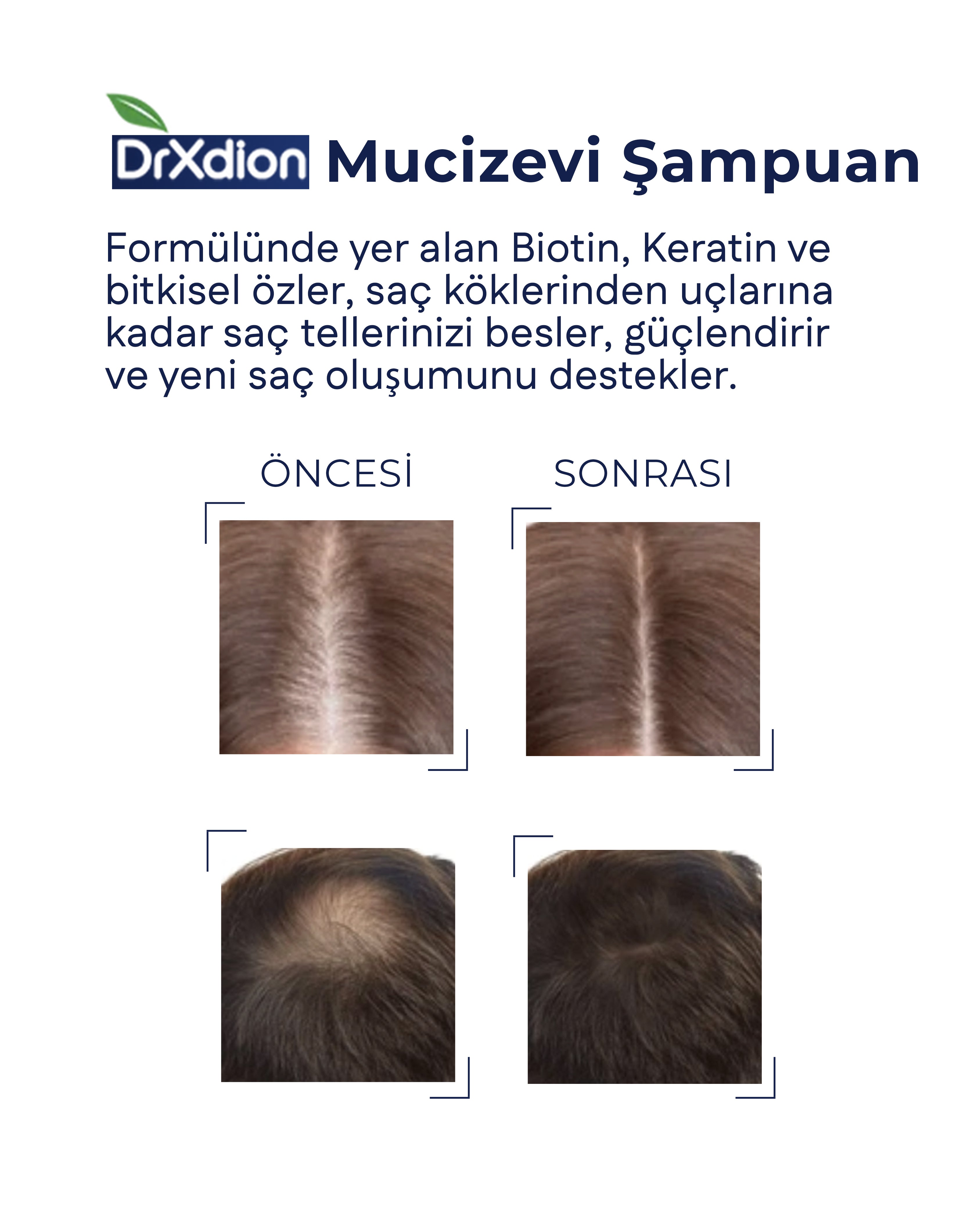 DrXdion Yüksek Dökülme Karşıtı Biyotin, Keratin, Arginine, Kolajen, Hyaloronoig Acid İçeren Şampuan (1000 ml)