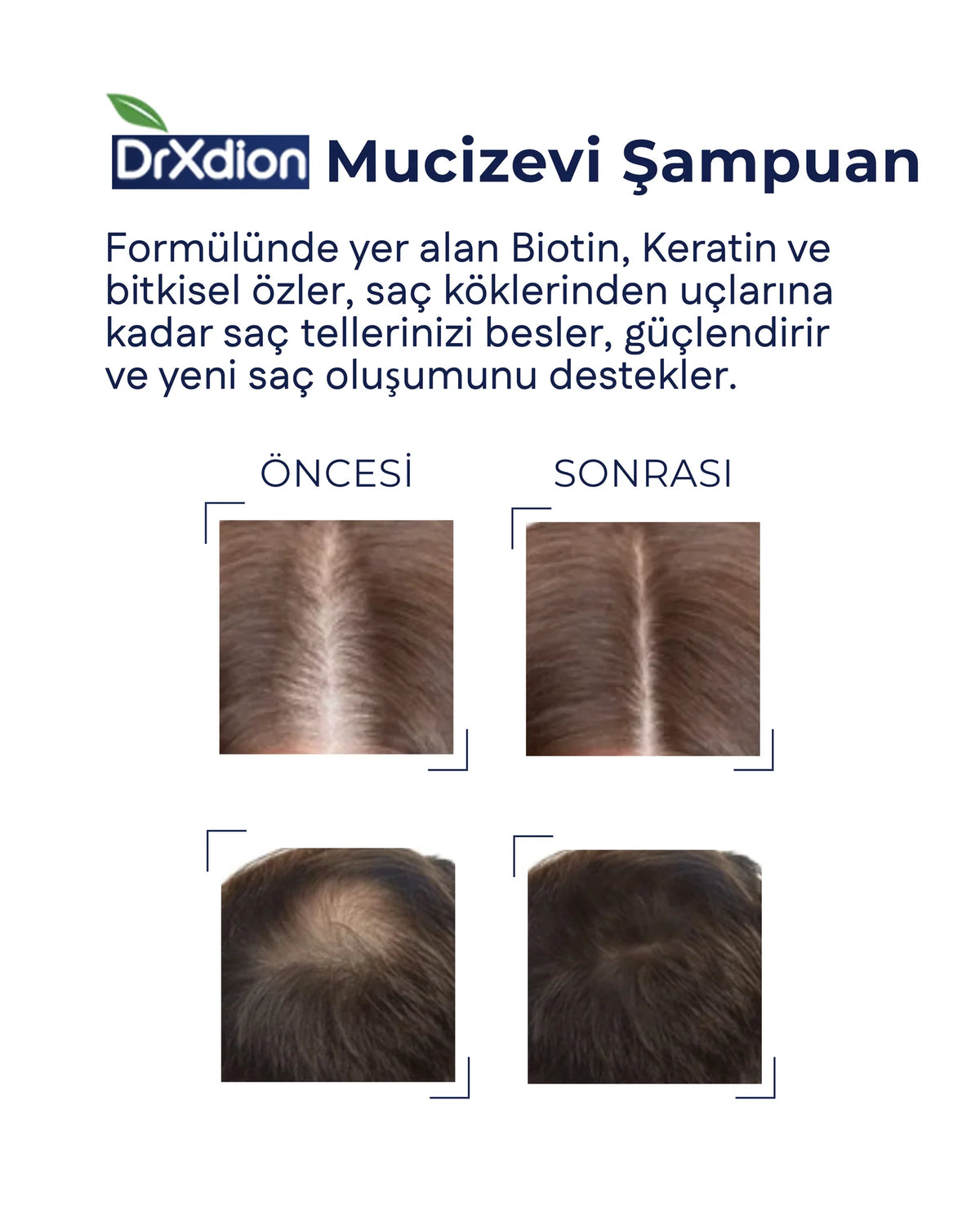 DrXdion Hair Restorative Şampuan – 8 Bitkisel Aktif + Keratin, Biotin & Arginine – SLS İçermez – Tüm Saç Tipleri – 500 ml
